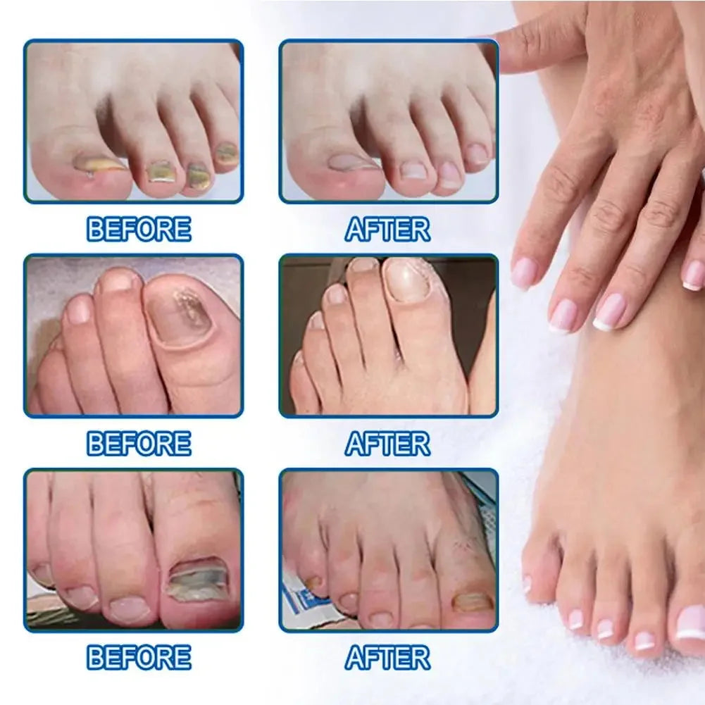 Adesivos de Restauração Discretos para Unhas com Fungos — foto 5